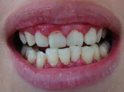 急性牙龈乳头炎