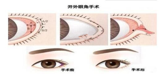 开外眼角