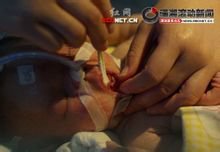 先天性出龈牙齿