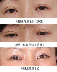 双眼皮修复术