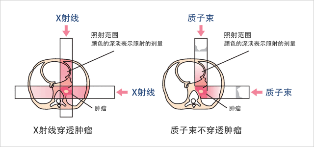 质子束疗法