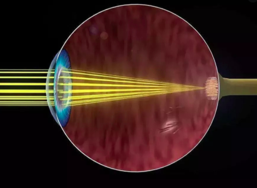 视网膜植入物