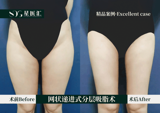 北京星医汇大腿吸脂 夏天就是露腿的季节！