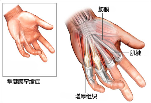 腱膜病