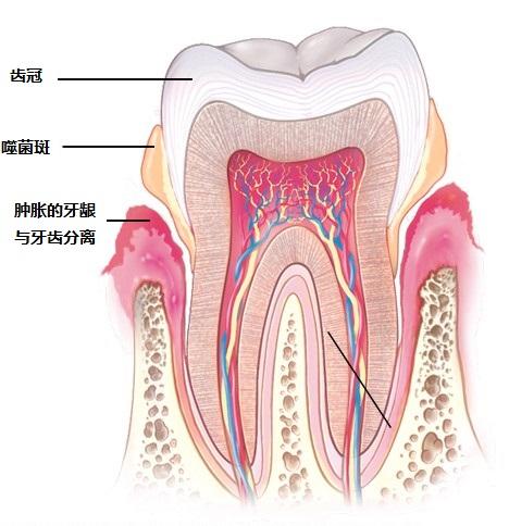 坏死性牙周病