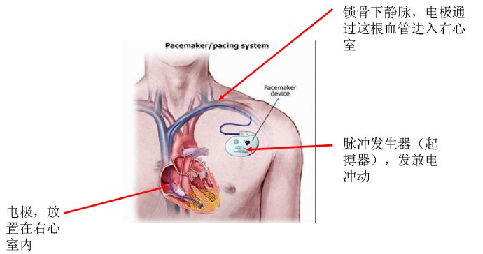 临起搏器安装部位图解图片