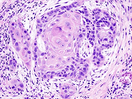 皮肤鳞状细胞癌切片图片