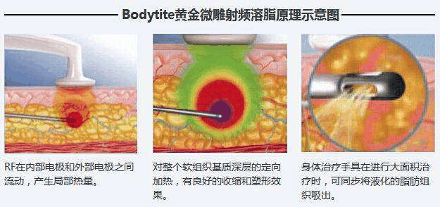 射频皮肤收紧