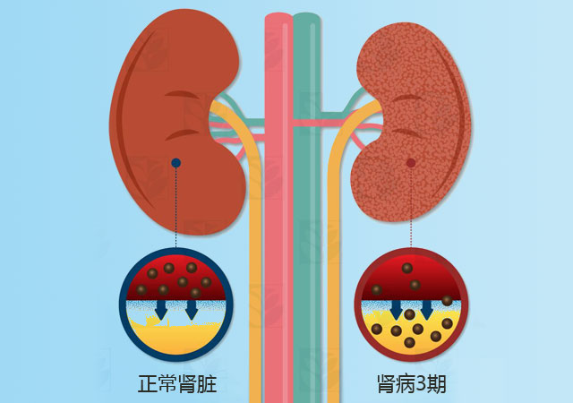 慢性肾病