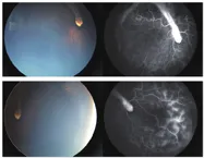 运动诱导性失明