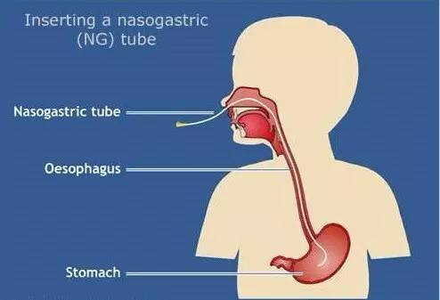 鼻胃管