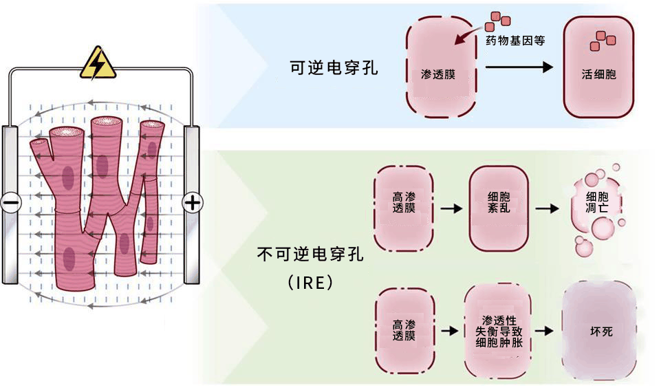 不可逆性电穿孔