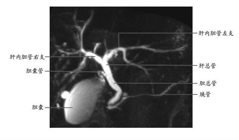 磁共振胰胆管成像