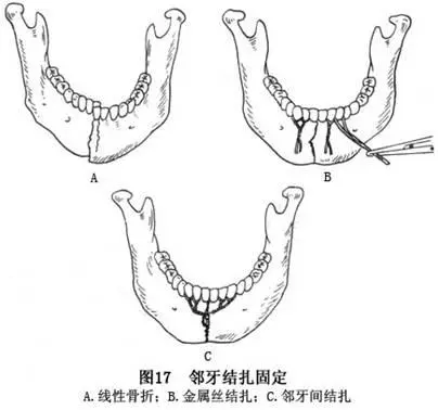 下颌骨折