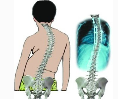 脊柱后凸畸形